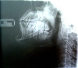 röntgen a fogászatban